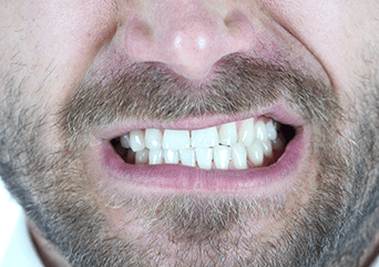What is bruxism and is it related to TMJ/TMD?